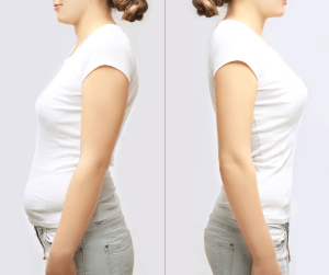 A side by side of a woman standing with good posture and bad posture. This images highlights how the difference in your stance and the way you hold yourself can alter your posture. 